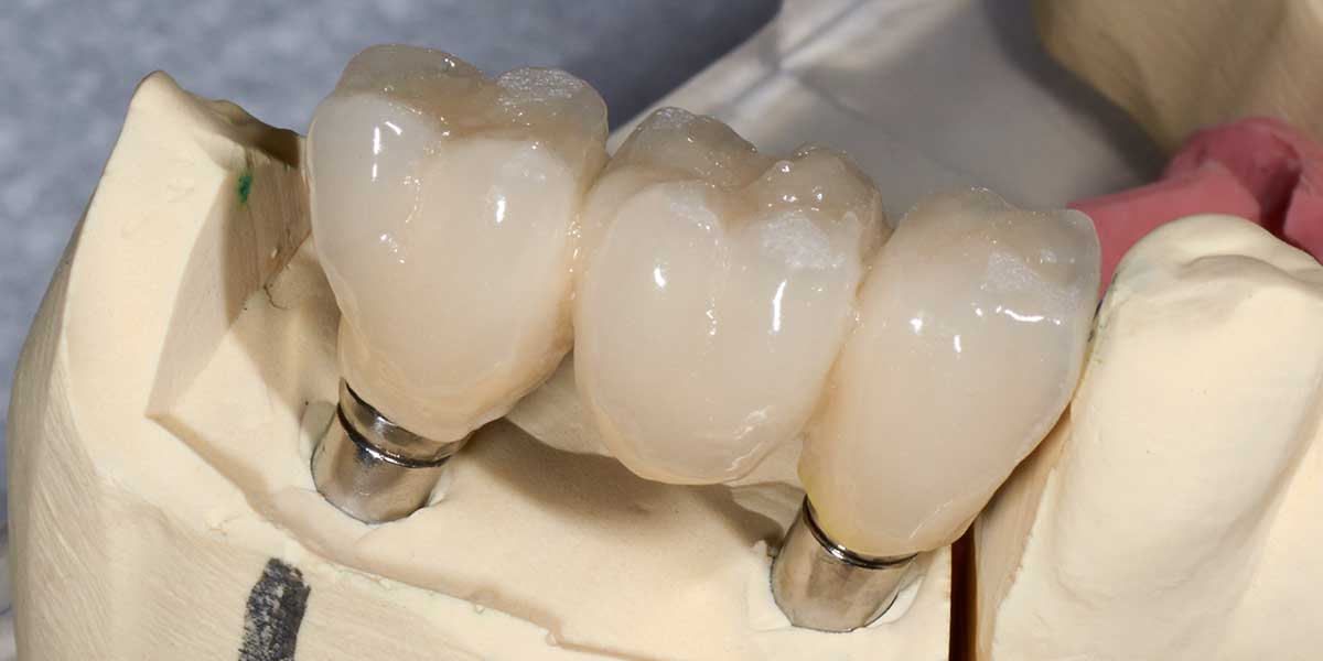 Single Tooth Dental Implant Illustration