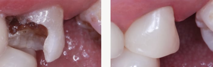 Porcelain Crowns