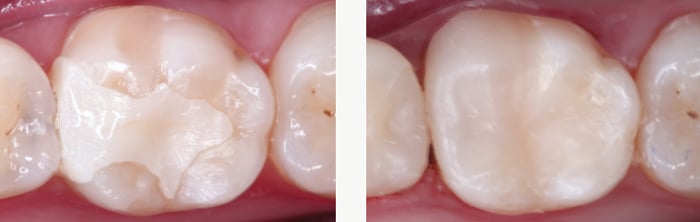 Porcelain Crowns