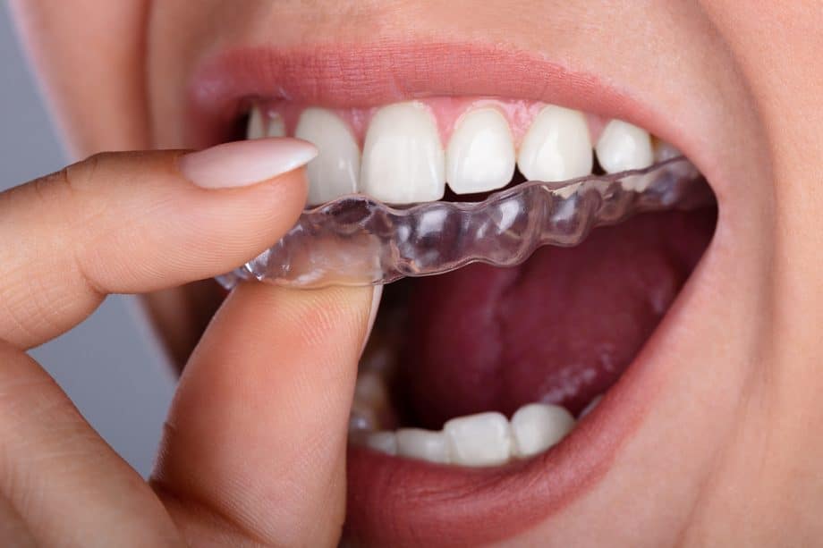 Invisalign clear aligner tray going into mouth