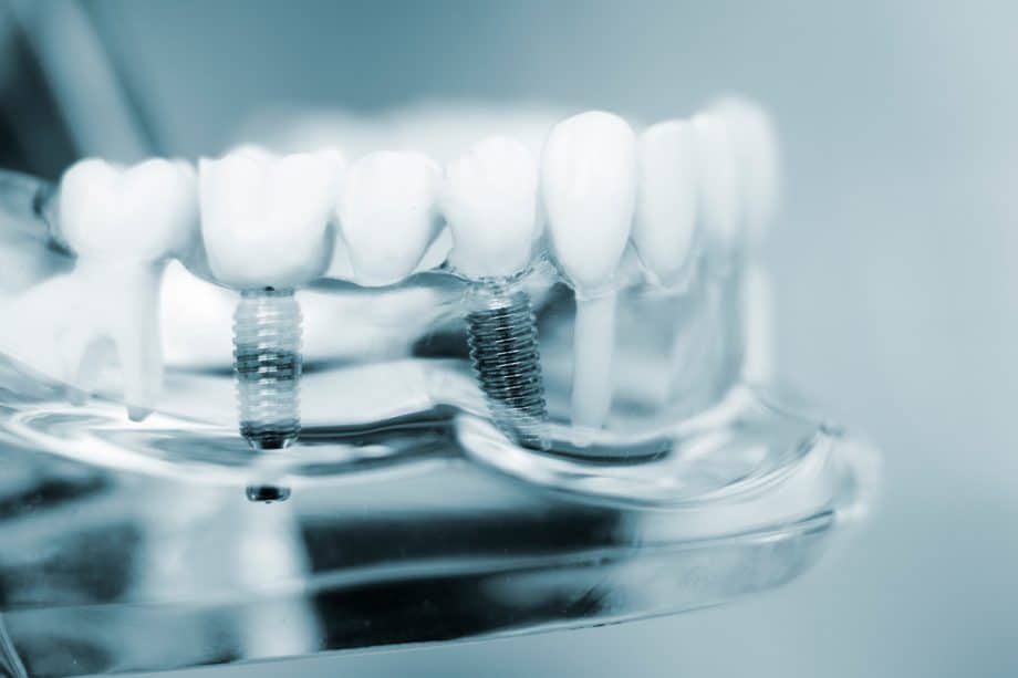 clear model of dental implants
