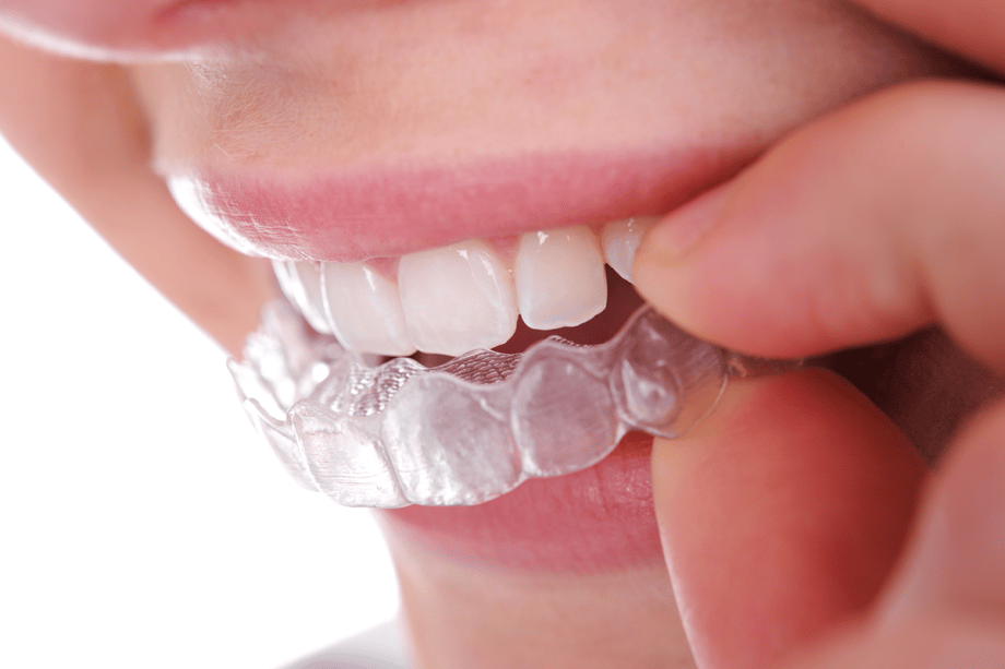 an Invisalign aligner tray being inserted into mouth